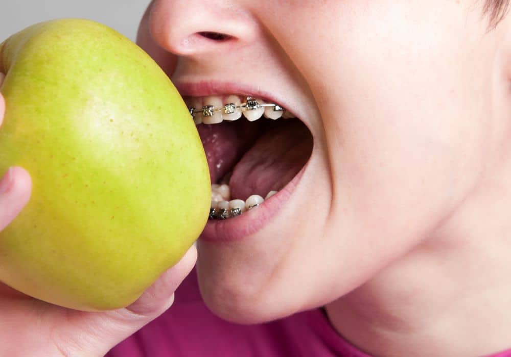 What Kind of Food You Should Avoid to Eat With Braces